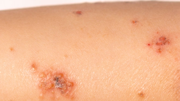 Impetigo sores Arm of a child with impetigo lesions.