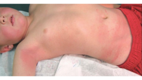 — title missing — Picture of a patient exhibiting the typical rash associated with scarlet fever.