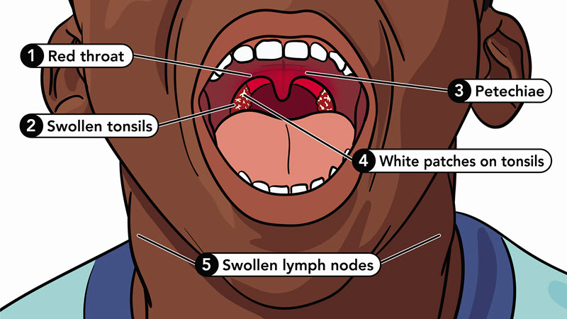A labelled illustration of the inside of the mouth of a person with strep throat