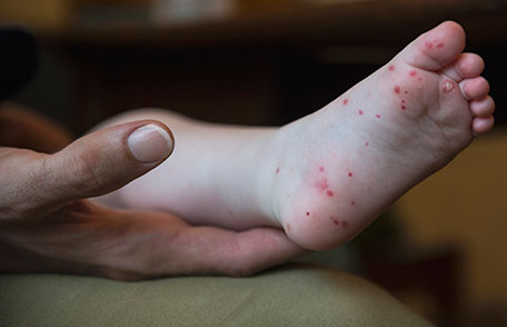 hfmd-childs-foot Mother holds child's foot and shows a rash of red spots.