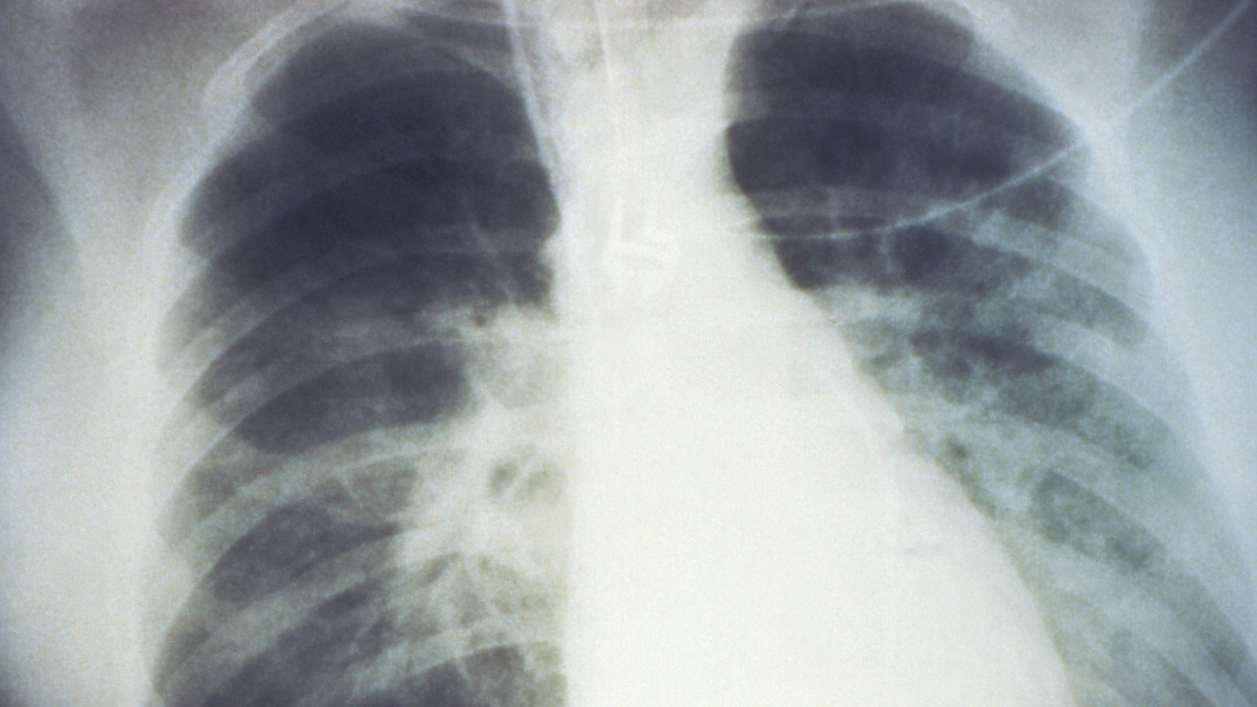 HPS chest xray black and white chest xray
