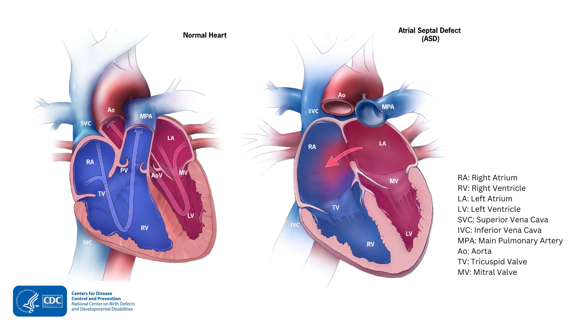 — title missing — Comparison of a normal heart and one with an ASD