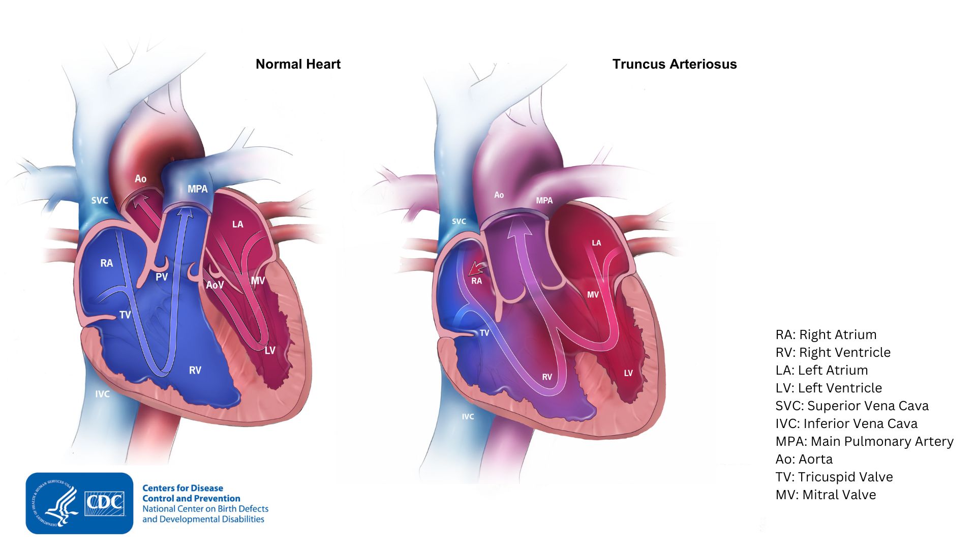 Diagram of heart with truncus arteriosus and a normal heart Diagram of heart with truncus arteriosus and a normal heart