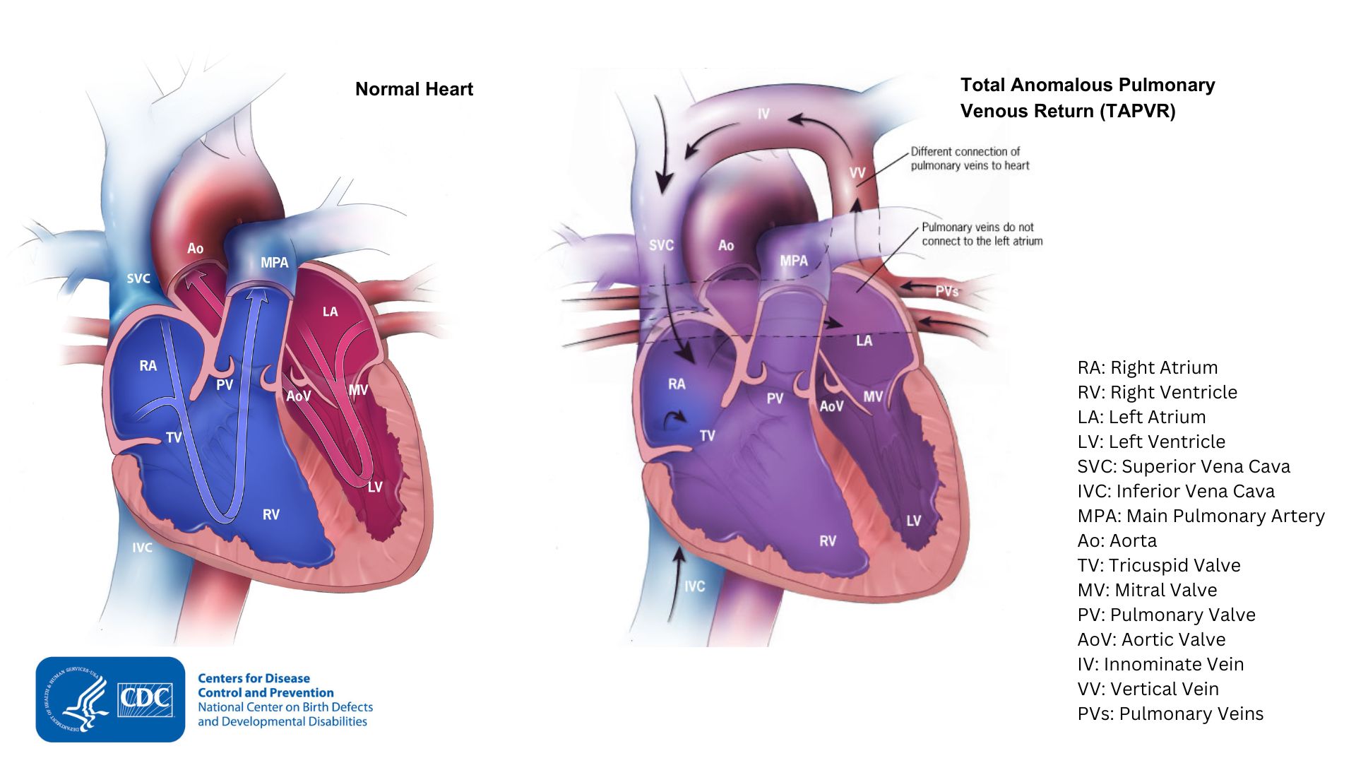 — title missing — Comparison of a heart with TAPVR to a typical heart