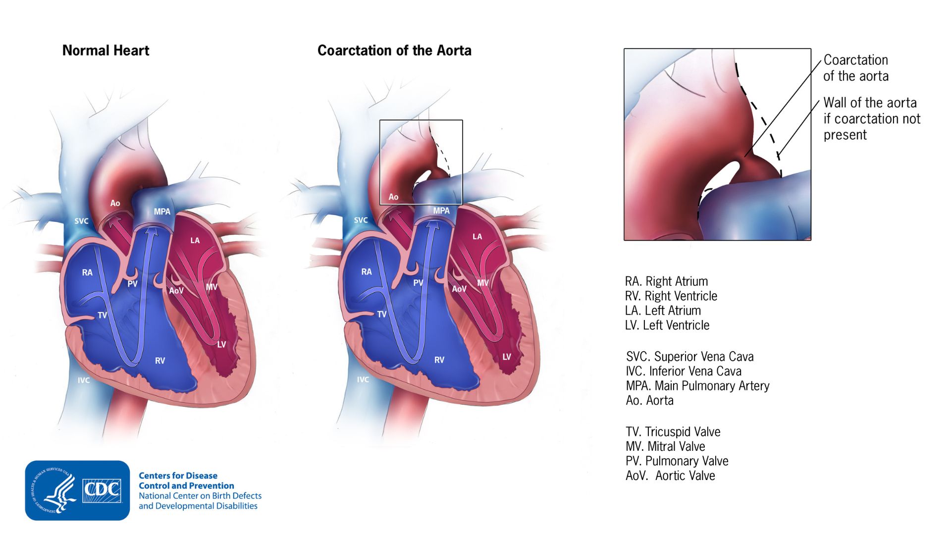 Coarctation of Aorta Normal heart to the left, heart with a coarctation of the aorta in the middle, and an enlarged view the coarctation in the upper right