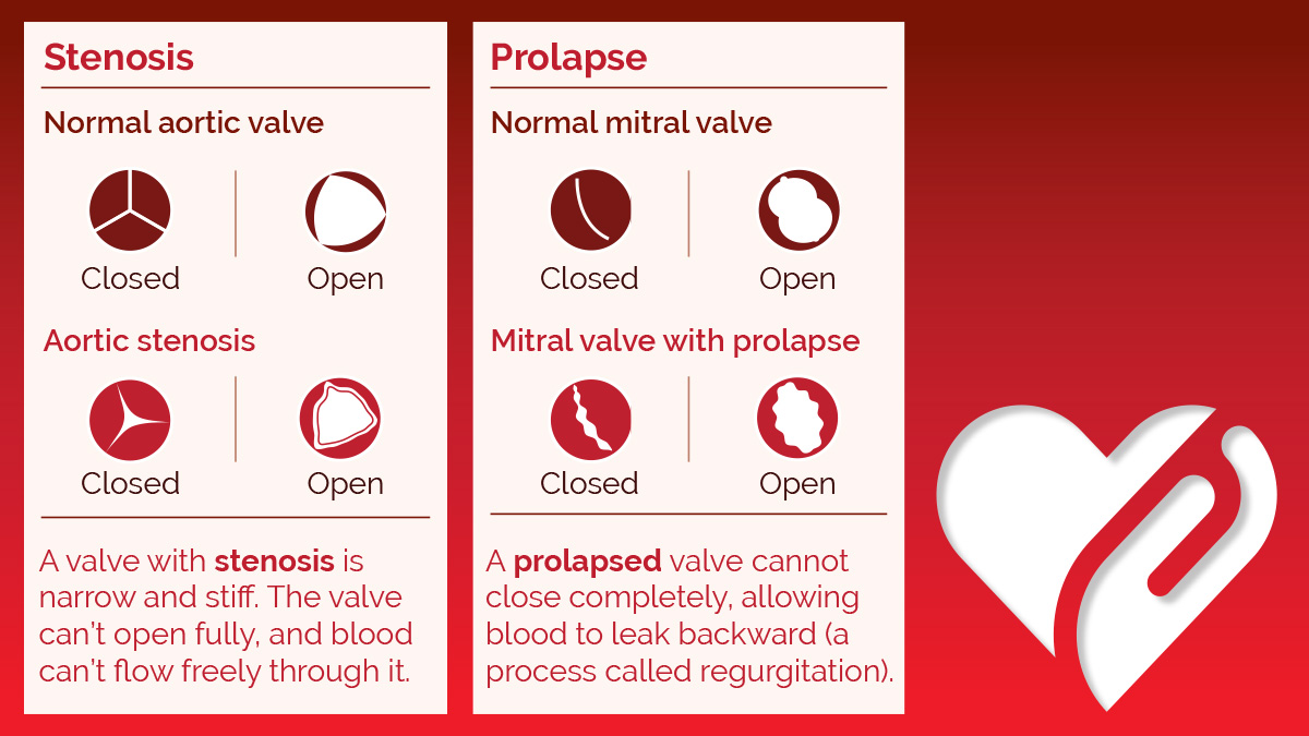 About HVD webpage image 2 Figures with text explaining stenosis and prolapse and eight small images illustrating open and closed positions of both normal and diseased versions of aortic and mitral valves. A valve with stenosis is narrow and stiff. The value can't open fully, and blood can't flow freely through it. A normal aortic valve, when closed, has three equal-sized slice-shaped flaps within a circle that close to form a Y-shaped seal. When open, the normal aortic valve has the flaps open to form an almost perfect circular cross-section with very small protrusions into the blood flow. An aortic valve with stenosis, when closed, has flaps that do not form a Y-shaped seal, instead leaving a cavity at the junction of the flaps where blood can trickle through. When open, the flaps are not fully open, forming a smaller, triangular cross-section. A prolapsed valve cannot close completely, allowing blood to leak backward, a process called regurgitation. A normal mitral valve, when closed, has two gibbous moon-shaped flaps that forma parenthesis-shaped seal. When open, the normal mitral valve has flaps open that form an almost perfect circular cross-section with very small protrusions into the blood flow. A mitral valve with prolapse, when closed, has two gibbous moon-shaped flaps that do not seal, leaving several gaps between the valves where blood can trickle through. An open mitral valve with prolapse has flaps that do not fully open, forming a smaller, elliptical cross-section.