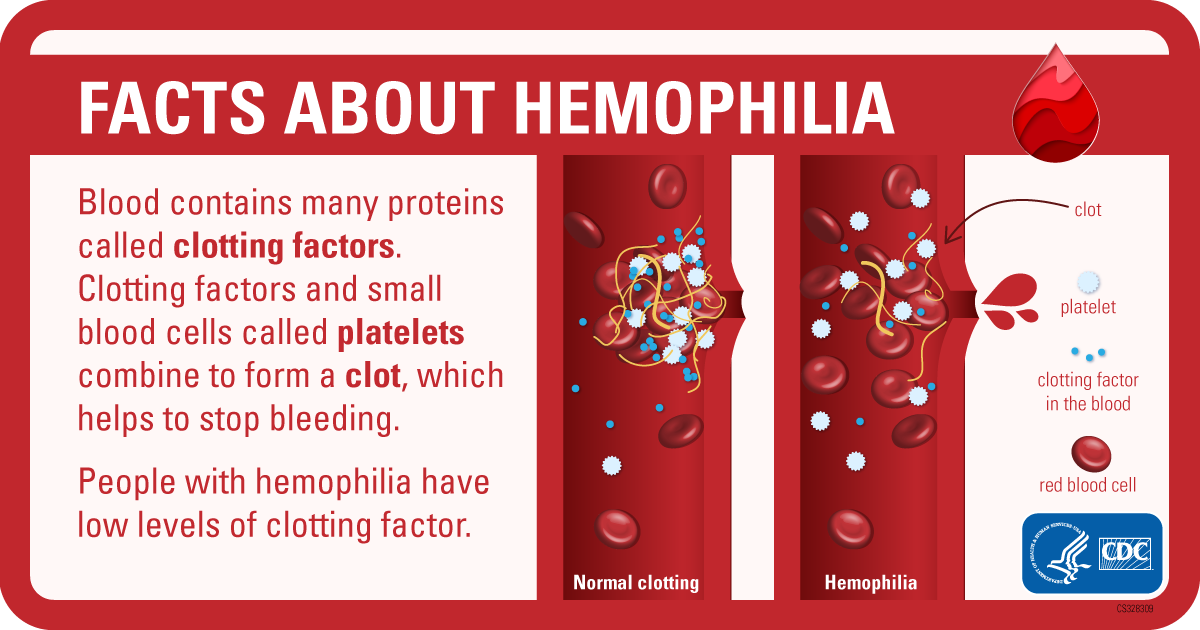 Image of a vein with normal blood clotting and clotting that happens if you have hemophilia
