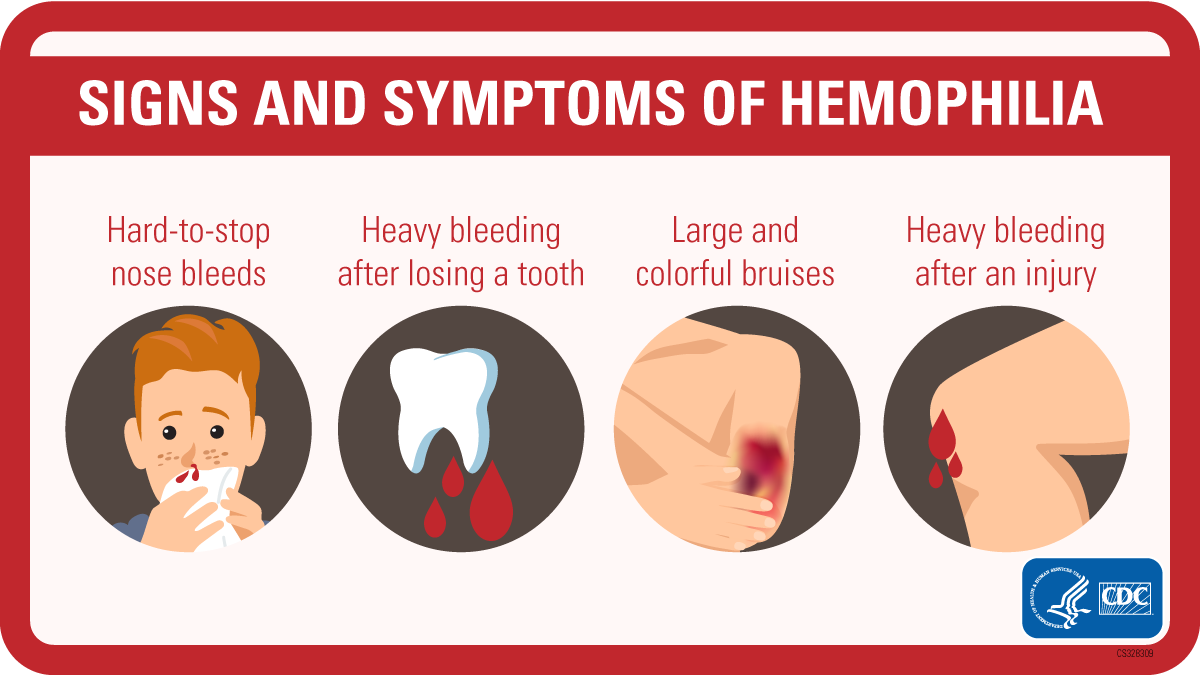 Pictures of the most commons signs of hemophilia, including nose bleeds, heavy bleeding after losing a tooth, large bruises, and heavy bleeding after injury