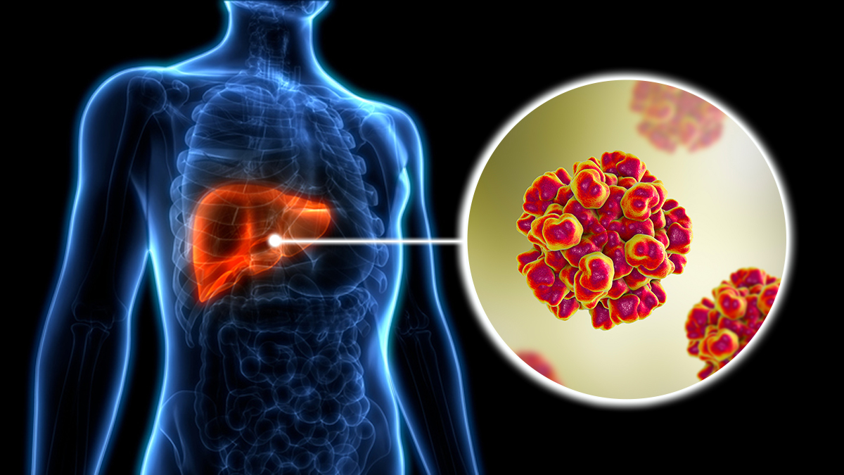 Hepatitis E Overview Thumbnail Artist rendition of the hepatitis E virus on the body