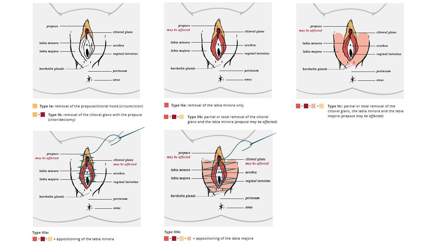 Figure 1. Clinical Drawings of FGM/C Types I, II, and III Figure 1. Clinical Drawings of FGM/C Types I, II, and III
