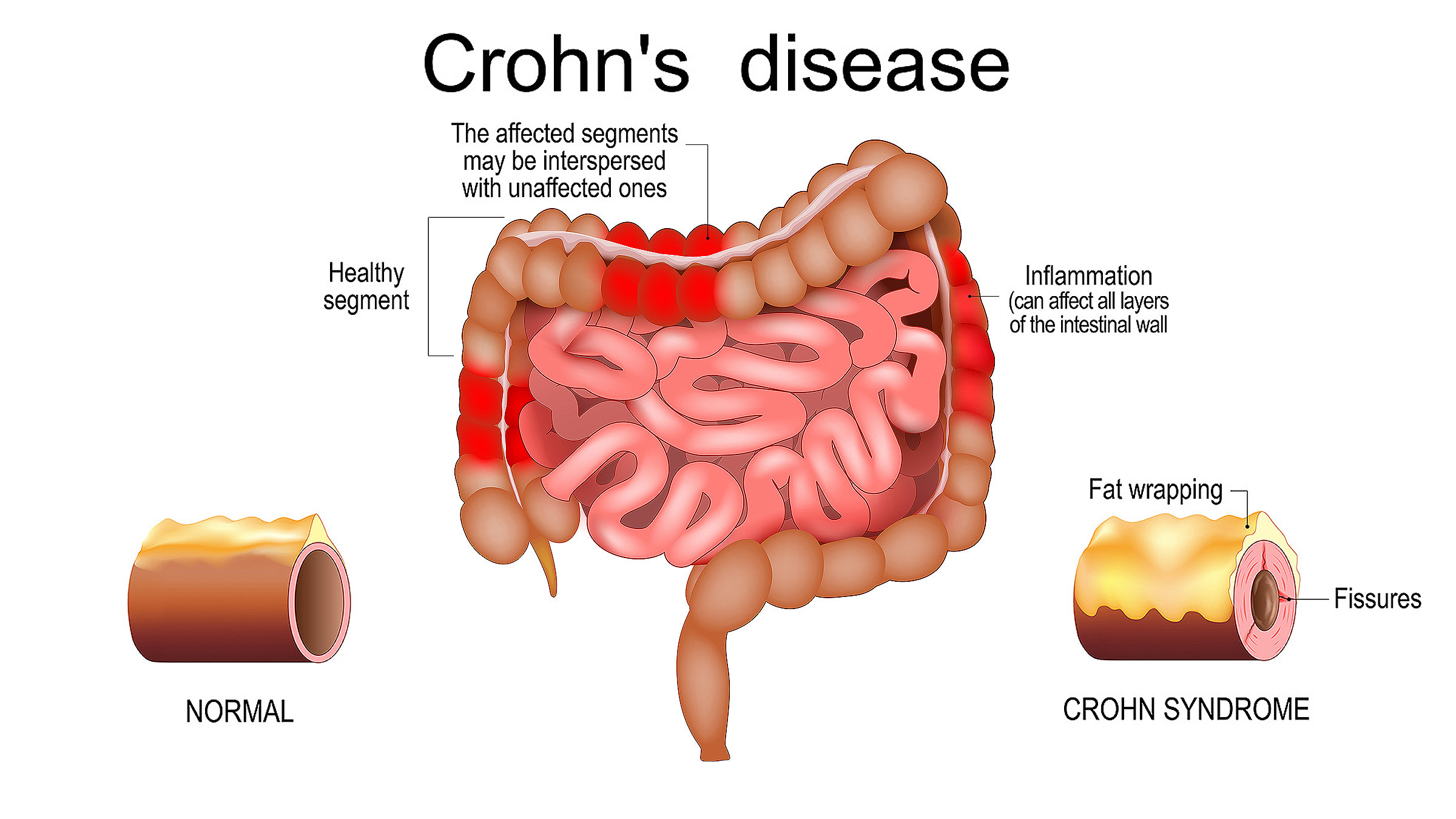 IBD Crohn's Graphic Illustrated diagram showing inflammation from Crohn's disease.
