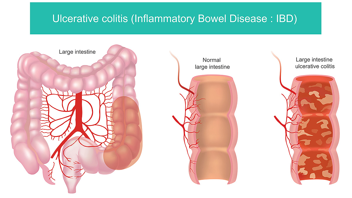 UC Graphic Illustrated diagram of a colon showing inflammation on the lining of the intestines.