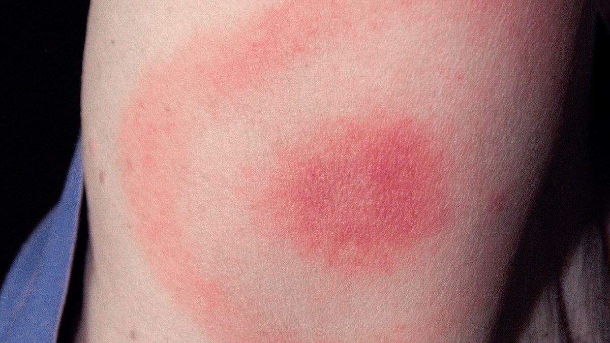 Circular red rash with central clearing that slowly expands
