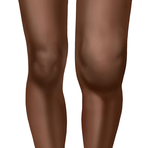 arthritic_knee Image showing swollen arthritic knee