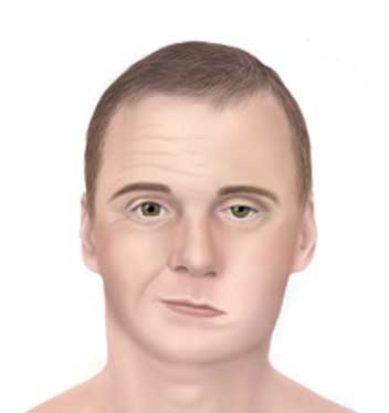 facial-palsy-nld Man displaying symptoms of facial palsy