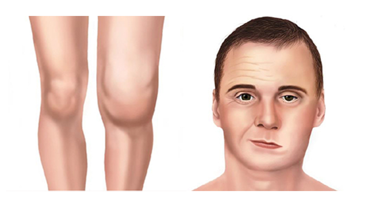Later signs and symptoms Later signs and symptoms of Lyme disease include swollen knees, irregular heartbeat, and facial palsy.