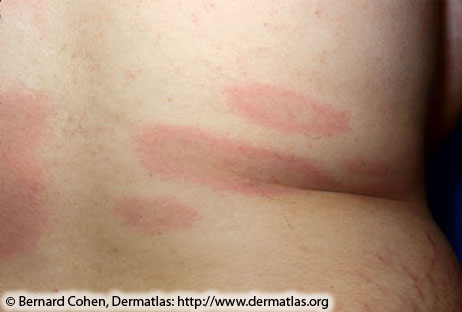 Close up image of a human's back, with multiple red rashes in the shape of ovals across their lower back.