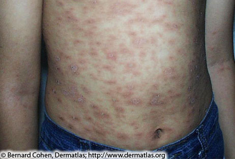 Image of a person's torso with small, raised, reddish-brownish rashes spotted throughout their entire stomach surface.