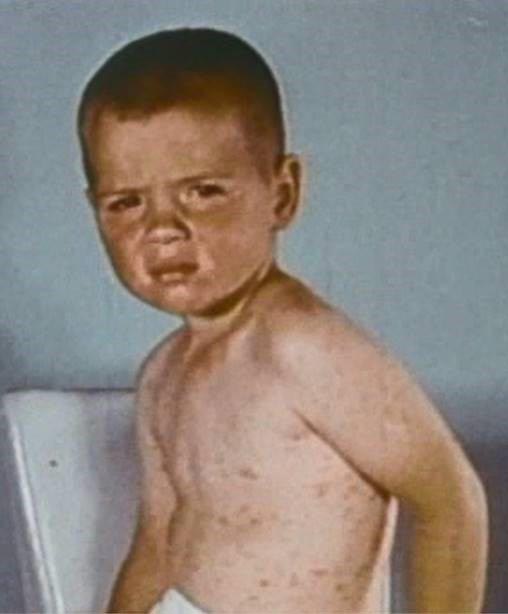Young boy 5 to 6 days into illness with rash and cough