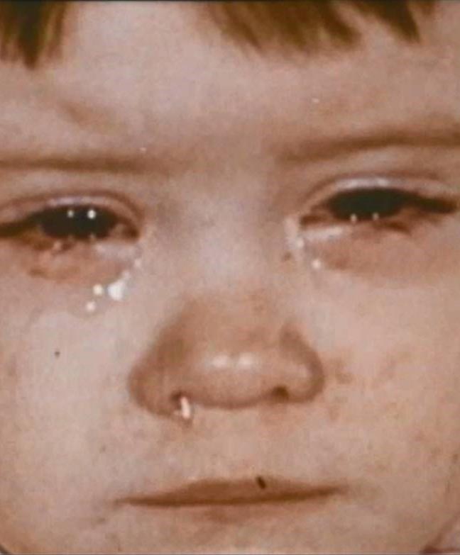 Young child with moderate illness: runny nose, teary eyes caused by measles infection.