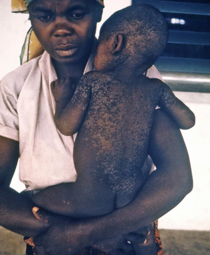 This late 1960s photograph shows a Nigerian mother and her child who was recovering from measles; note that the skin is sloughing on the child as he heals from his measles infection.