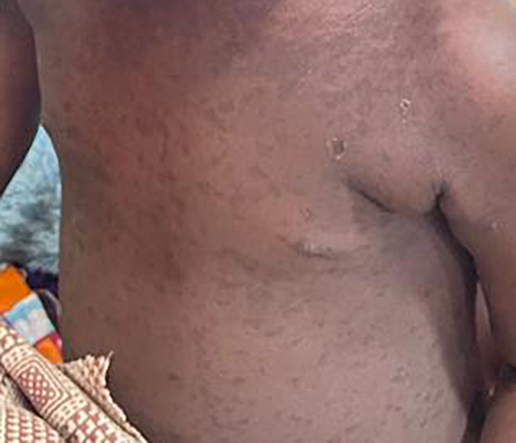 Image of measles rash on the torso of a child with darker skin.