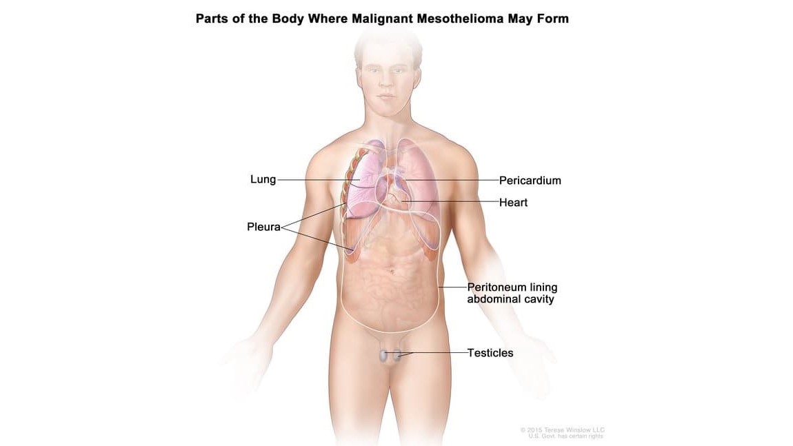 Mesothelioma Diagram Drawing shows parts of the body where malignant mesothelioma may form.