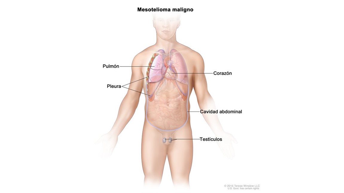 Mesothelioma Diagram Spanish Diagrama que muestra partes del cuerpo donde se puede formar mesotelioma maligno