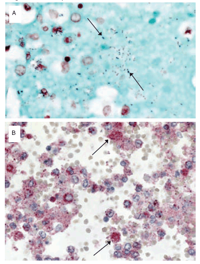 The Figure consists of two slides showing Streptococcus pneumoniae infection in a patient with confirmed pandemic H1N1 virus infection.