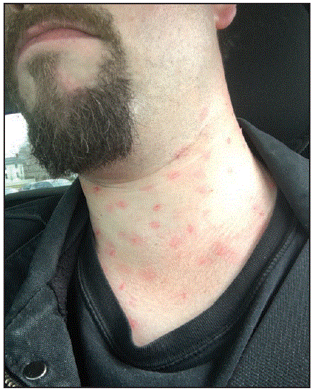 m6636a2f1 The figure above is a photograph showing a patient actor displaying a moulage-simulated measles rash in mystery patient drills in New York City during December 2015–May 2016.