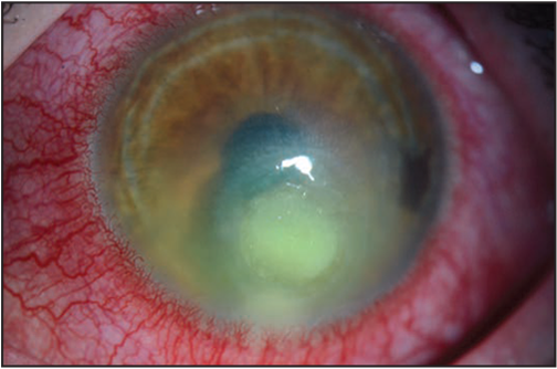 mm6732a2-F The figure above is a photo that shows findings characteristic of a contact lens–related corneal infection.