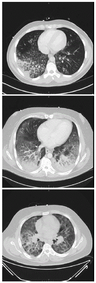 mm6836e1-F1 The figure consists of three computerized tomography images showing diffuse lung infiltrates in three patients with e-cigarette–associated severe lung disease in North Carolina, during July–August 2019.