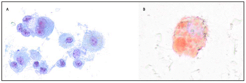 mm6836e1-F2 The figure shows microscopy of a bronchoalveolar lavage sample (Papanicolaou stain and oil red O stain) from a patient with acute lung injury associated with vaping in North Carolina, during July–August 2019.