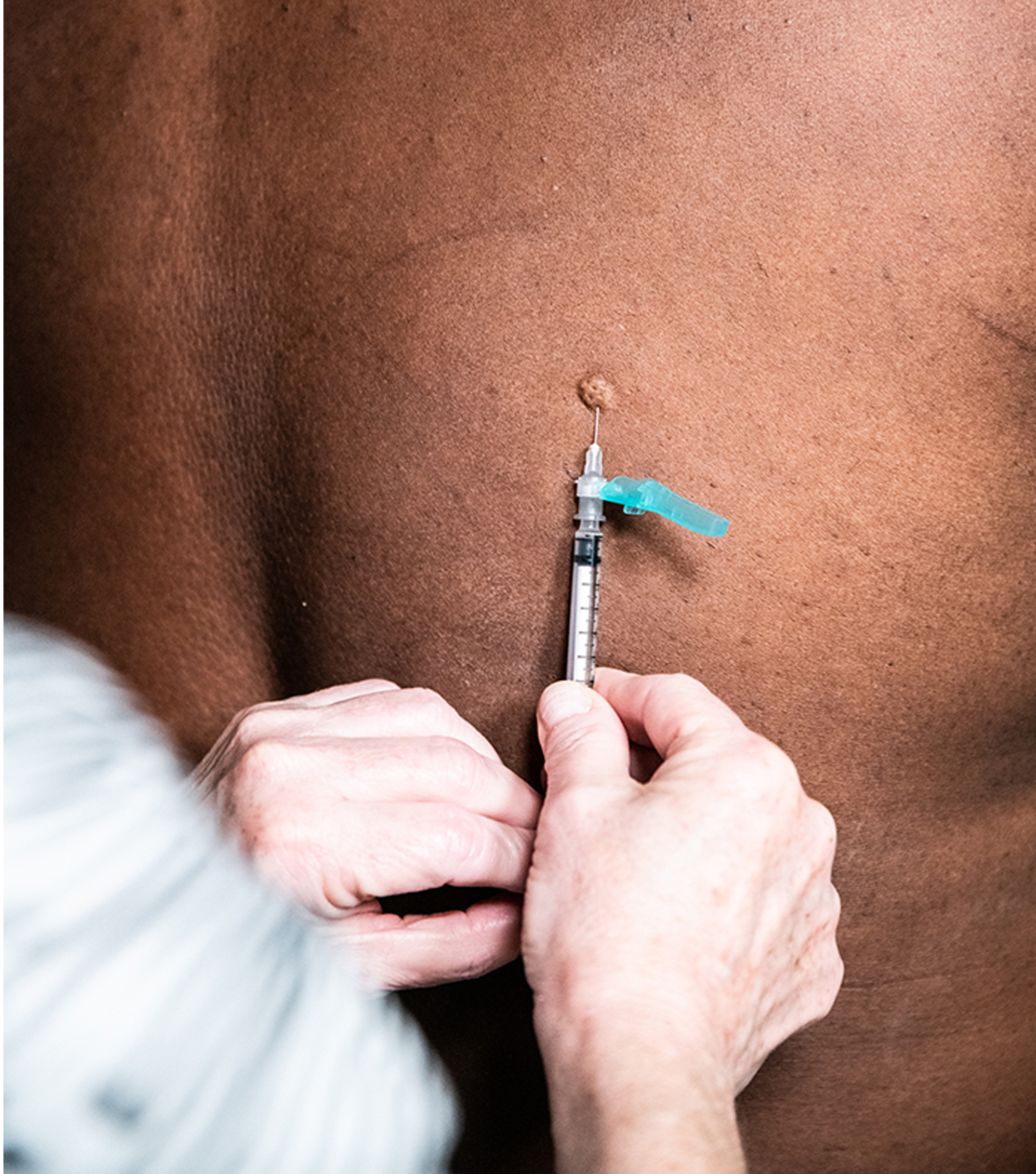 Mpox Injection Site 3 Image of a hand inserting a vaccination into a dark-skinned person's upper back.