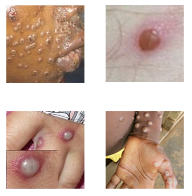 Mpox Key Characteristics Four photos of mpox rashes on different parts of the body