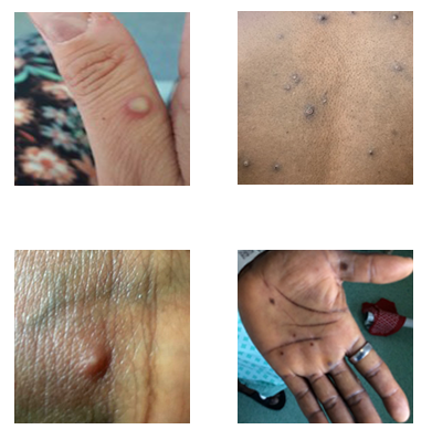 Mpox rash photos Four photos of mpox rashes on different parts of the body.