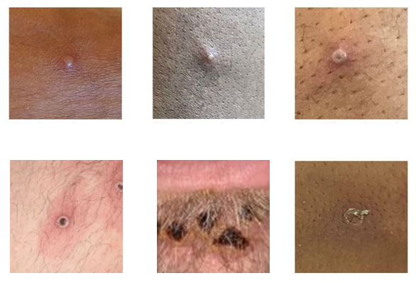 Mpox rash examples Six photos of mpox lesions on different skin tones and types.