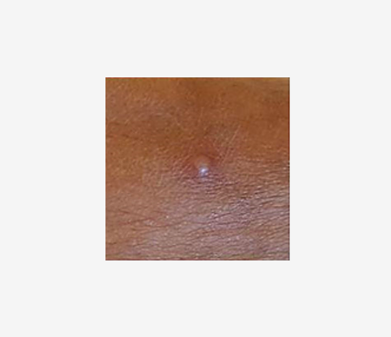 Mpox rash 1 Close up photo of a small bump on a dark-skinned person. The bump is blister-like.