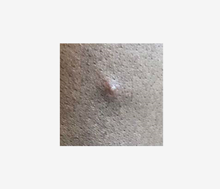 Mpox rash 2 Close up photo of a small bump on a light-skinned person. The bump has a white center.