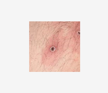 Mpox rash 4 A photo of two lesions on a light-skinned person. The lesions are round and have black centers. The skin around the lesions is reddened.