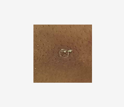 Mpox rash 6 Close up photo of a round lesion on a dark-skinned person. The lesion has a white middle and is white around the edges.