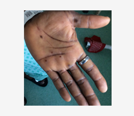 Mpox rash 8 Photo of a dark-skinned person's hand with multiple dark bumps