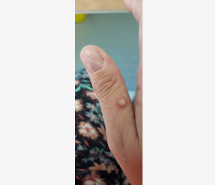 Mpox rash 9 Photo of a small, raised bump on on person's thumb