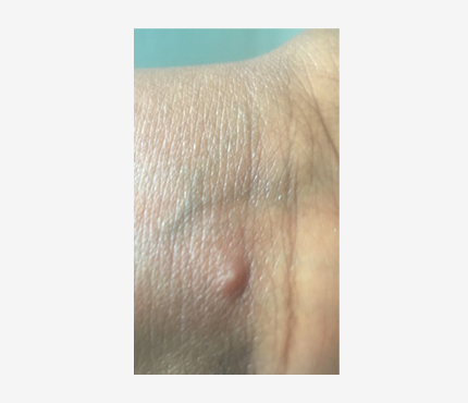 Mpox rash 10 Photo of a small raised bump on a dark-skinned person's inner wrist