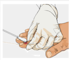 collecting mpox specimen Healthcare provider collecting an mpox specimen