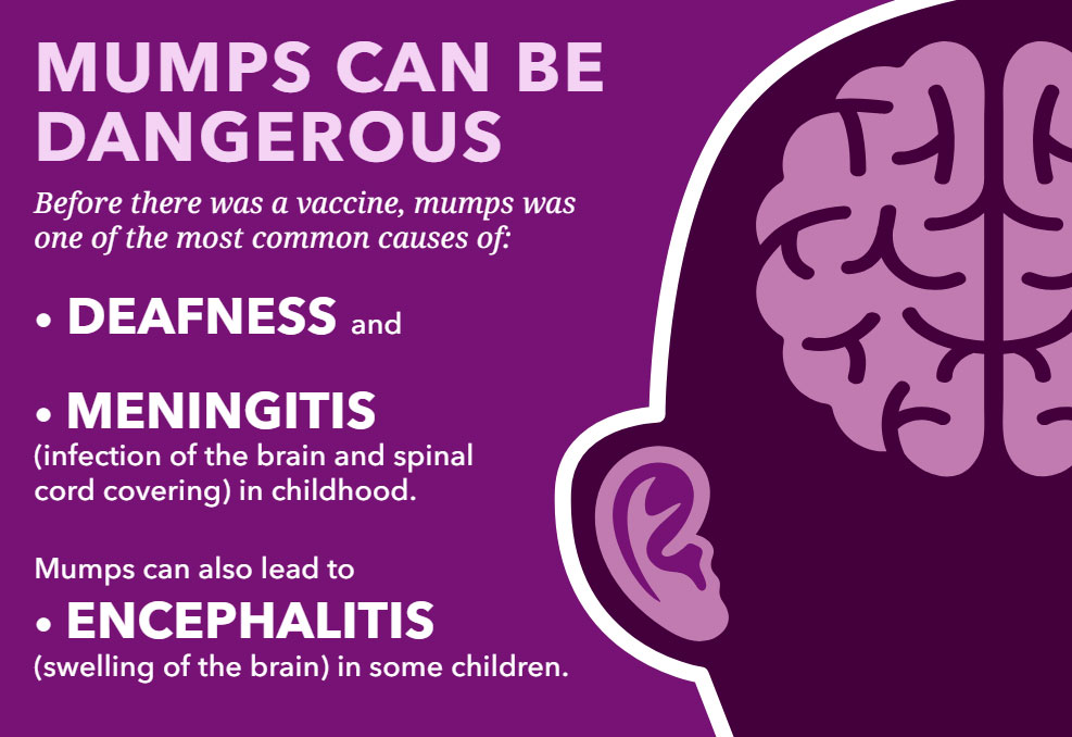 mumps-infographic-child