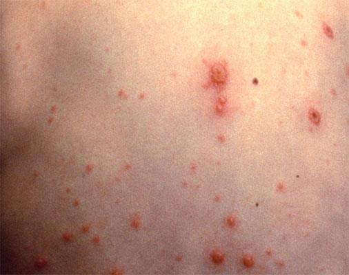 Chickenpox Chickenpox on back