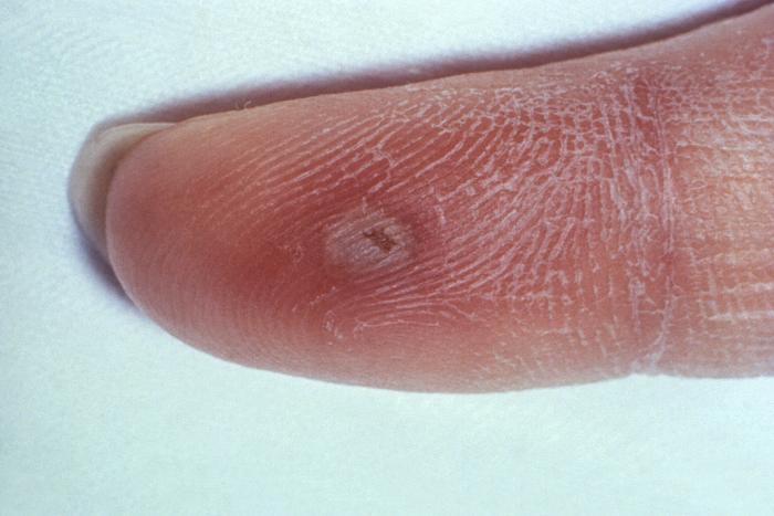Intro03 Lesion on a fingertip
