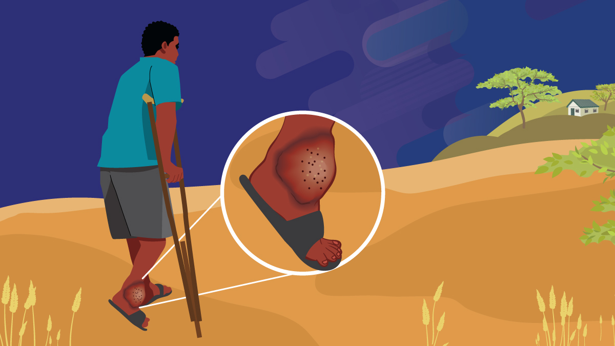 A man walking with crutches- zoom in shows mycetoma on the foot.