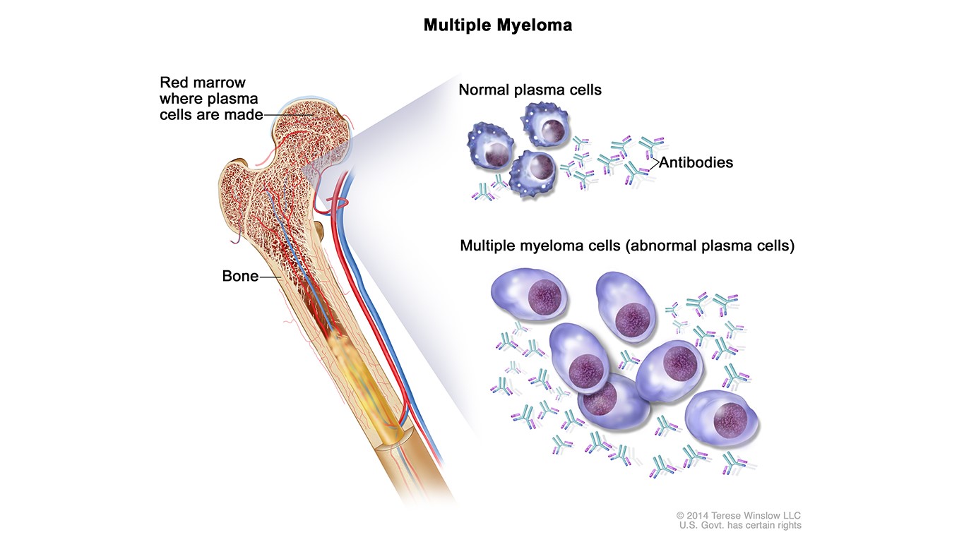 Multiple Myeloma Diagram Drawing shows normal plasma and multiple myeloma cells, or abnormal plasma cells, inside the bone marrow.